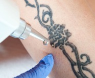 5 Things To Consider Before Getting A Tattoo Removal Service