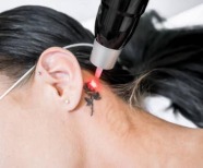 8 Reasons Why Laser Tattoo Removal is the Best Solution for Your Tattoo