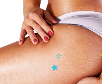 Are there any natural ways to reduce cellulite?