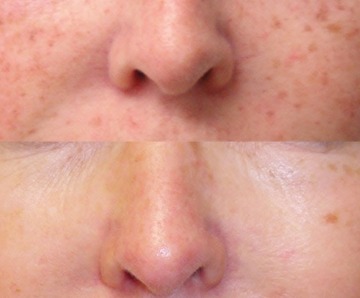 How to Remove Pigmentation From Face Permanently at Home?