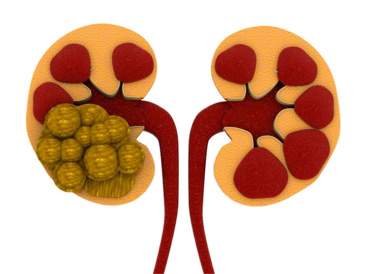 rid of kidney stones