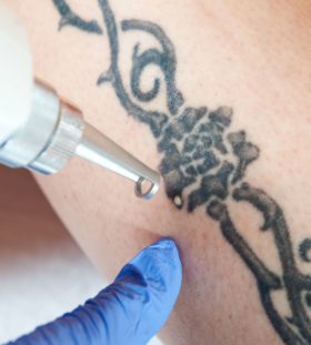 Tattoo Removal Service