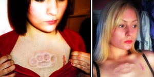 Subcutan Brass Knuckle Tattoo on Woman’s Chest