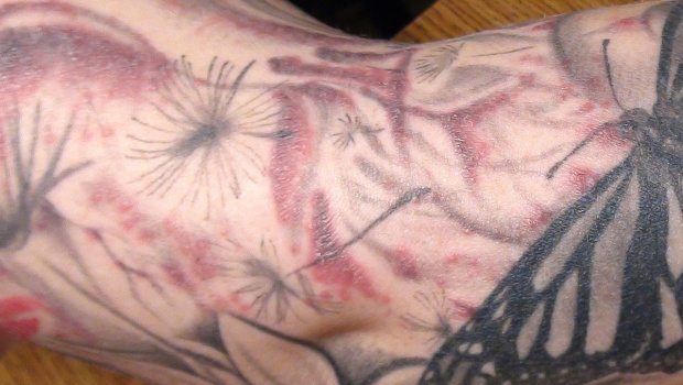 Tattoo Ink Causes Health Scare How To Identify Infection And