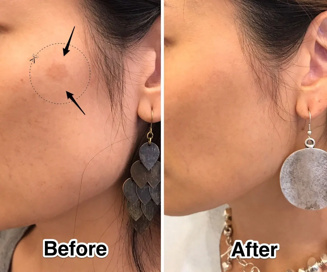Laser Treatment: What To Expect Before, After & During
