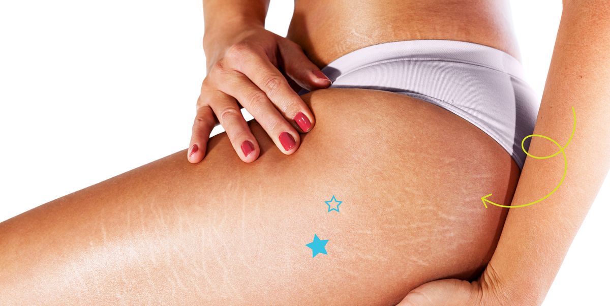 Are there any natural ways to reduce cellulite?